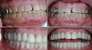 Full Mouth Reconstruction